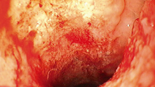 12 days after the start of treatment the cavity is completely cleaned of dirty fibrin coatings and covered in clean granulation tissue.