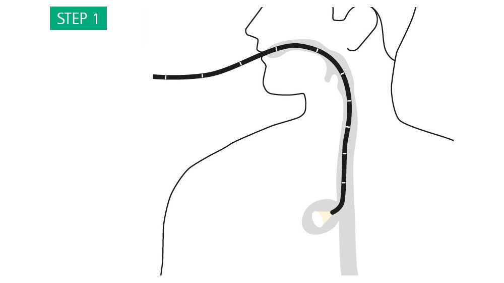 Illustration: The wound cavity should be measured with an appropriate endoscope. Cut the sponge slightly smaller than the cavity.