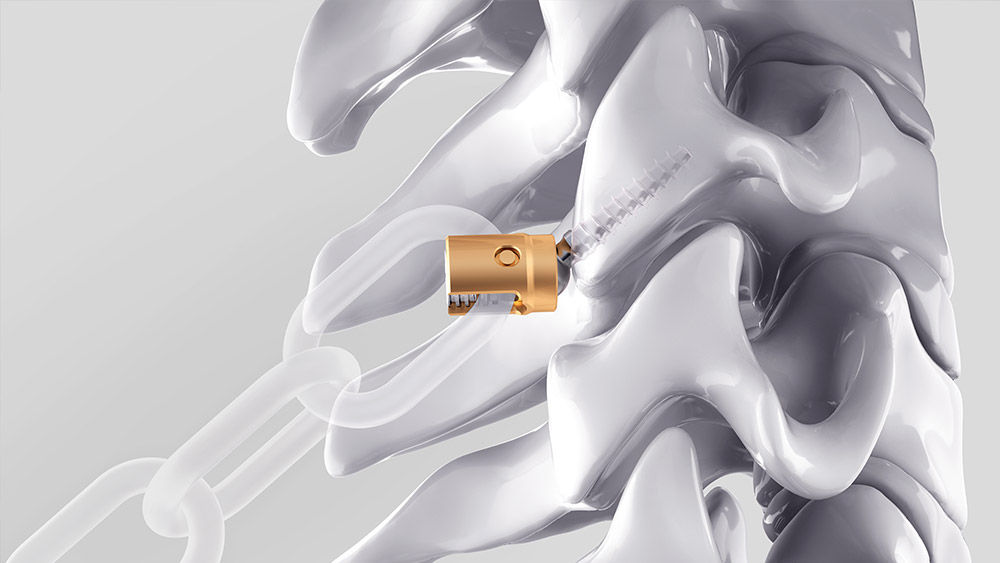 Ennovate® Cervical EnnoCore