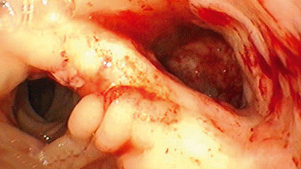 After 21 days treatment, a clear reduction in the size of the leakage cavity has taken place. The cavity is closing with granulation tissue from its depths. The size of the sponge system is continuously decreased from one system change to the next.