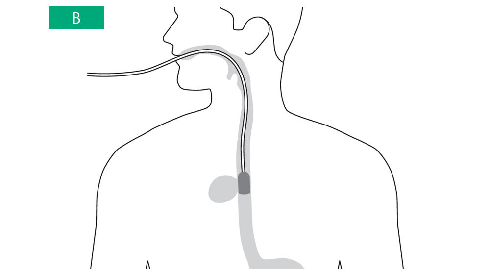 When intracavitary placement is challenging or not possible it is an option to place the sponge in the lumen in front of the defect: Intraluminal positioning. [14], [30]