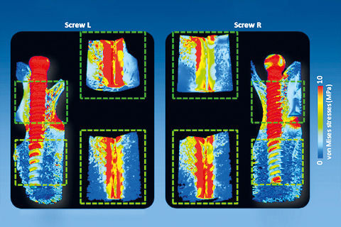 Micro-CT and micro-FE analysis of pedicle screw fixation under different loading conditions