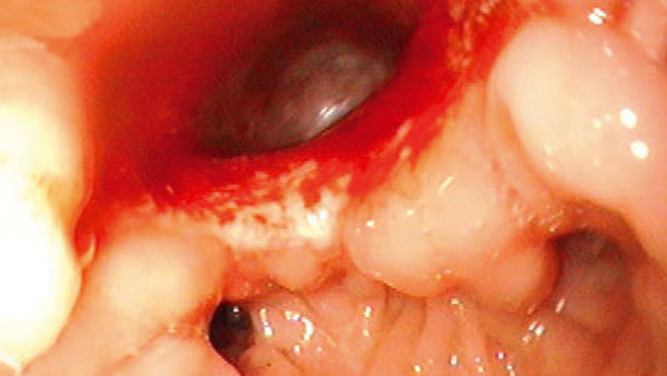 After 33 days treatment only a small residual hollow is identifiable. These hollows normally heal without additional treatment.