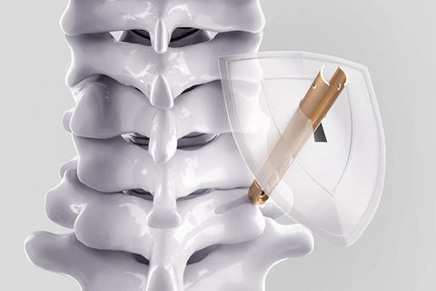 Chart about the effect of cement augmentation on pedicle screw fixation under various load cases