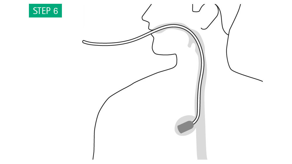 Illustration: The sponge will now expand in the leakage cavity. Check the position of the sponge using the endoscope to make sure that the sponge has not migrated and apply appropriate correction by means of endoscopic grasping forceps if necessary.