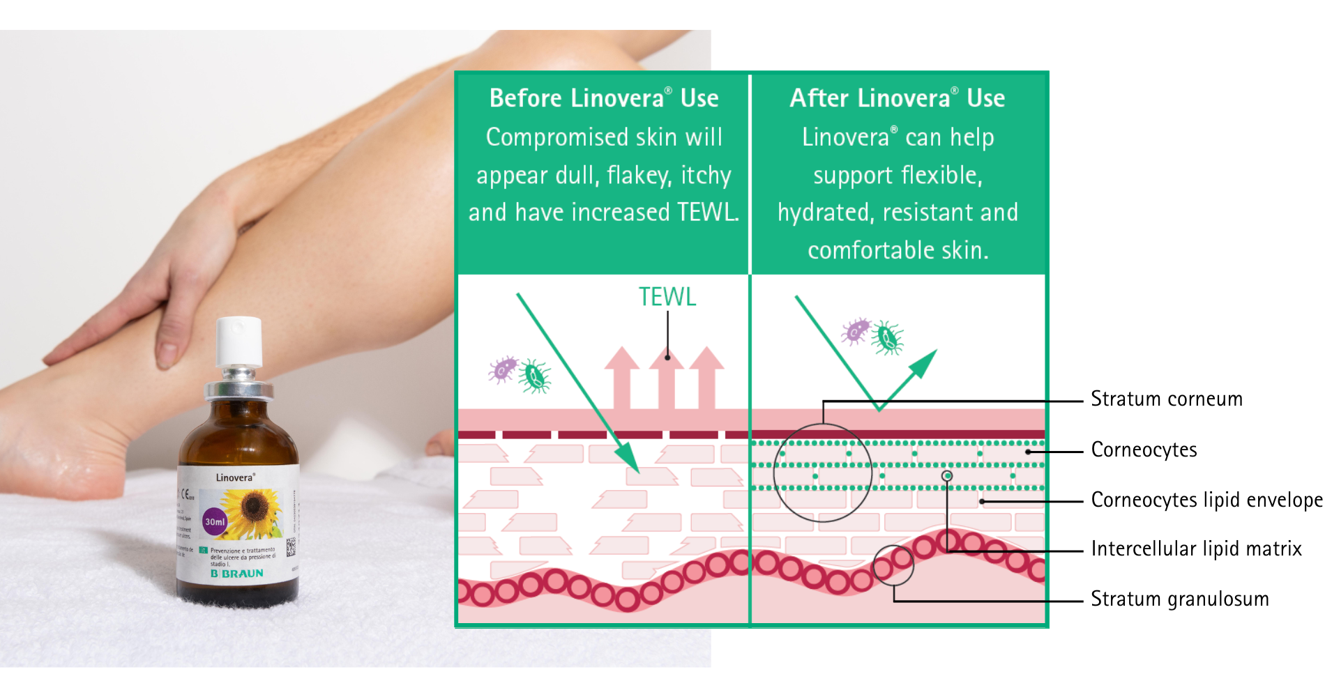 Stratum corneum - 1