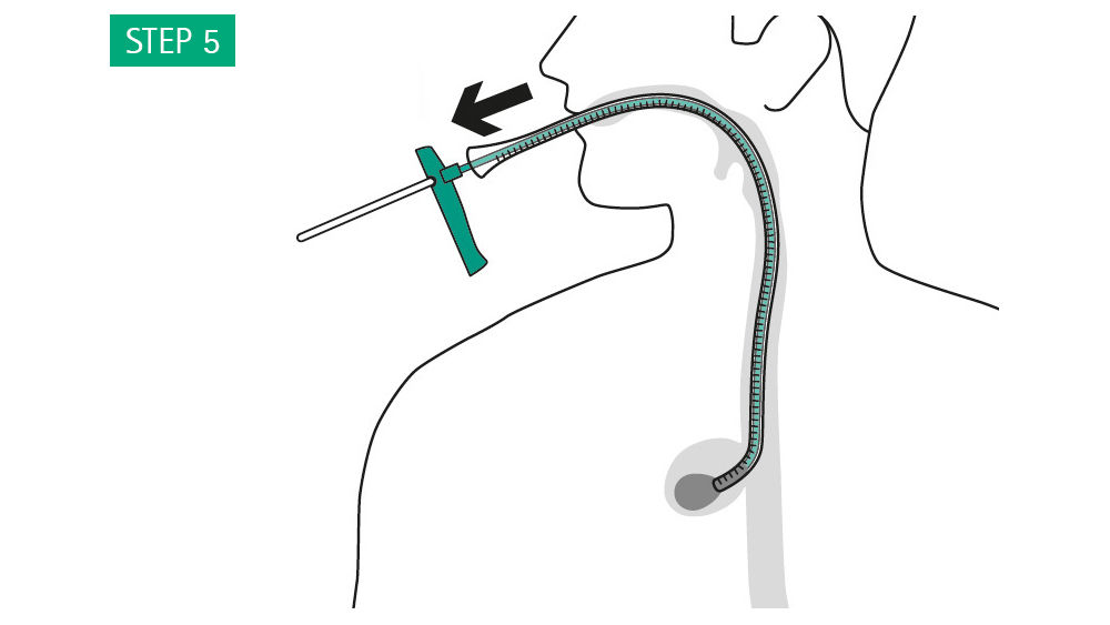 Illustration: Advance gently until the sponge is expelled from the overtube, the resistance will fade once the sponge is released. Withdraw the overtube and pusher together.