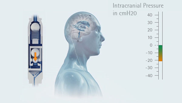 Graph intracranial pressure in the upright position