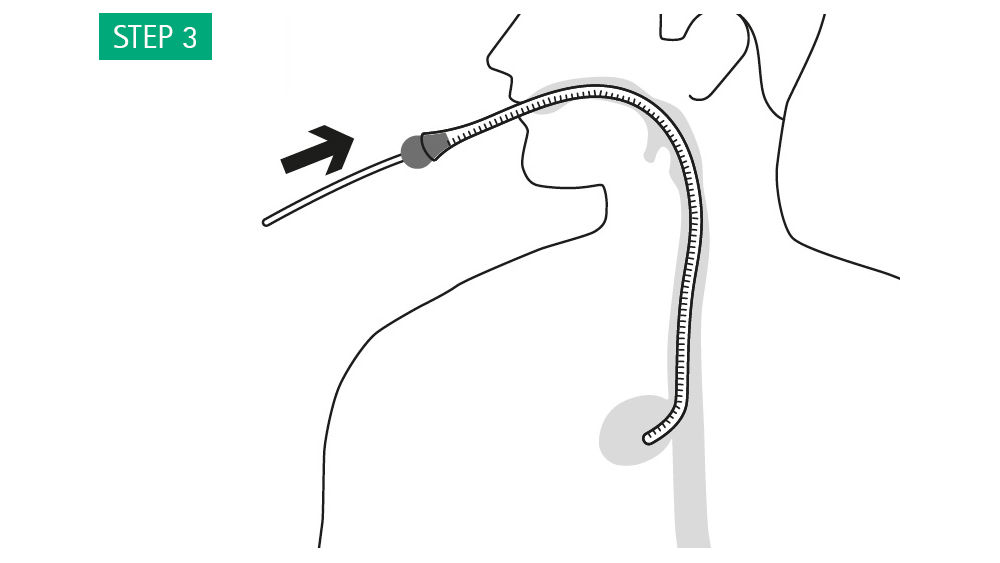 Illustration: After leaving the overtube in the required position, place the drain of the sponge inside the pusher and introduce the sponge, previously impregnated with sterile hydrogel based on glycerol, through the overtube.